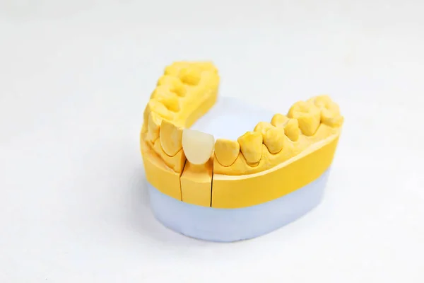 Implant Dentystyczny Przywrócenie Przedniego Zęba Dokładne Przywrócenie Utraconych Zębów — Zdjęcie stockowe