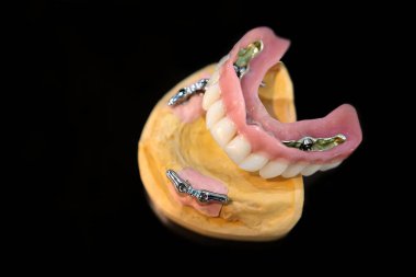 Siyah arka planda dişleri olan yapay bir çene. Diş implantları diş laboratuarında.