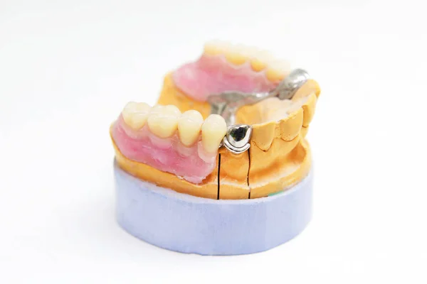 False Dentures Formation Modeling Oral Cavity — Stock Photo, Image