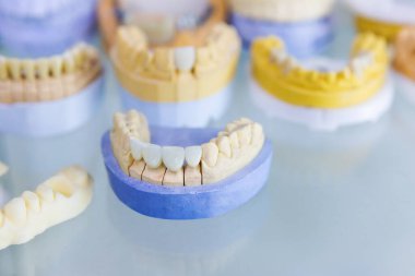 Diş implantı olan bir insanın çene yapısı. Diş üretimi ve protezleri. Diş Laboratuvarı.