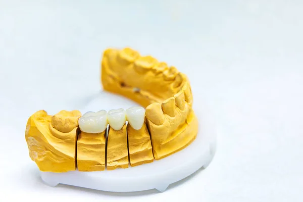 Implanty Dentystyczne Przywróć Utracone Zęby Most Dentystyczny Makiecie Szczęki Laboratorium — Zdjęcie stockowe