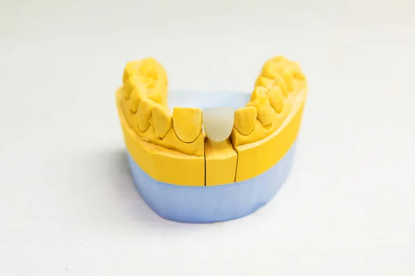 Prosthetic Teeth Restoration Front Tooth Dental Laboratory — Stock Photo, Image