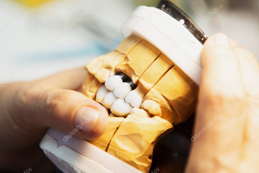 Manufacturing of dental implants. Formation of a bite on a plaster model of a human jaw