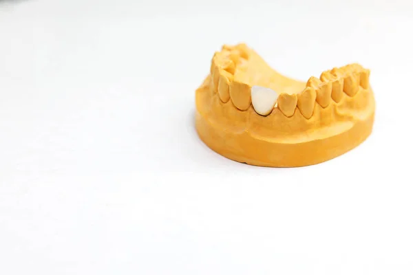 Implant Dentystyczny Robią Protezy Laboratorium Dentystycznym Szczęka Zębami Białym Tle — Zdjęcie stockowe