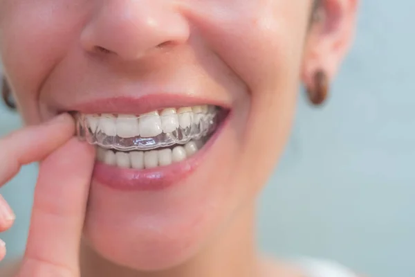 Μια Γυναίκα Που Φοράει Αόρατο Σιλικονούχο Της Οδοντιατρική Διόρθωση Κινητή — Φωτογραφία Αρχείου