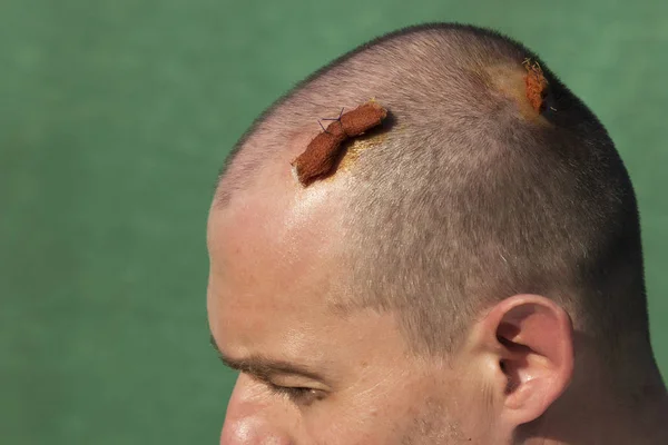 Removed fat tissue from man\'s head