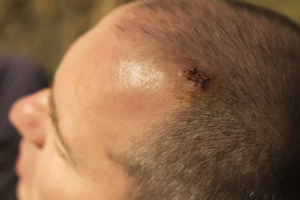 Man Fresh Scar His Head Removing Big Mole — Stock Photo, Image