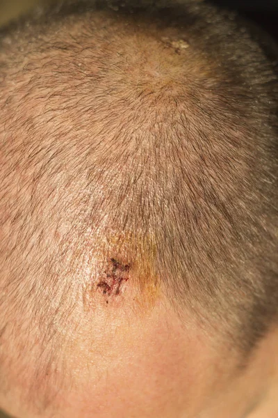 Two scars after removing fat tissue from head. Portrait view.