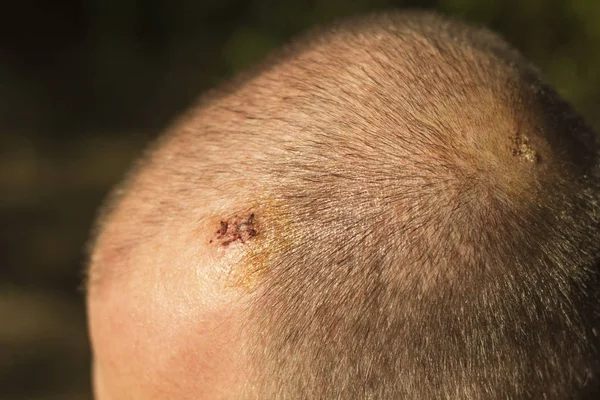 Duas Cicatrizes Depois Remover Tecido Adiposo Cabeça — Fotografia de Stock