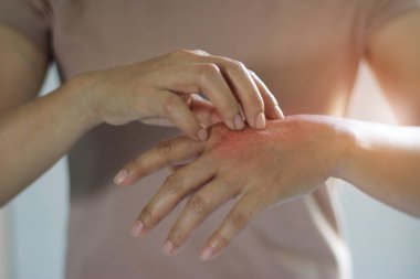 Sağlık ve tıp kavramı. Kadın elini kaşıntı deri hastalıkları, Kuru cilt, Anti, neden üzerinde kaşıntı tırmalamak kimya, deterjan veya bulaşık sıvı ve dermatit, böcek sokması, Alerjik yandı, uyuşturucu. Sağlık sorunu. 