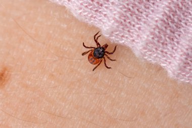 İnsan derisinde enfeksiyon kapmış kene. Ensefalit ve Lyme borreliosis enfeksiyonları taşıyor. Kıyafetlerin altında sürünen insanda parazit maytı var. Ixodes ricinus. Tehlikeli ısırgan böcekler.