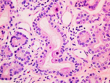 Tükürük bezindeki sitomegalovirüs CMV Enfeksiyonu 400x hemoksilin ve Eosin Lekeli Büyütme ile görüntülendi