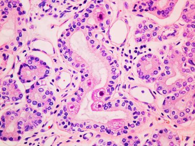 Cytomegalovirus CMV Infection in the Salivary Gland Viewed at 400x Magnification with Haemotoxylin and Eosin Staining clipart