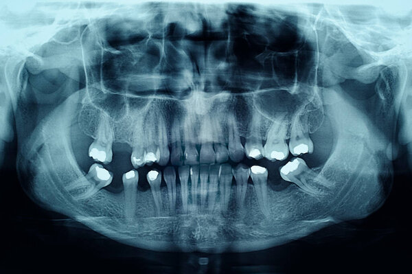 Dental X-Ray Showing Fillings in the Teeth
