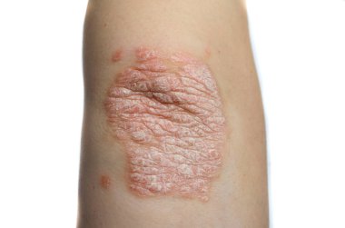 Yakın plan dirsek, beyaz bir arka planda deri hastalığı.