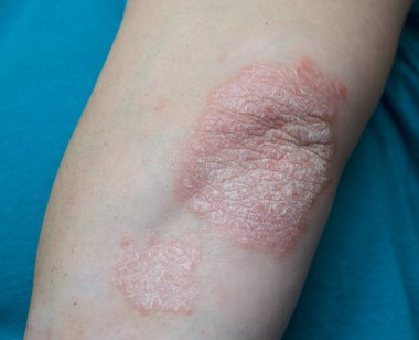 Deri hastalığıyla yakın plan dirsek.