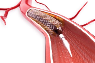 Balon Genişletilebilir Stent. Anatomik kavram