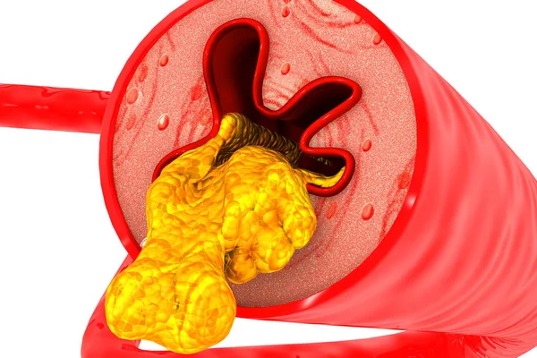 Arteria Bloqueada Con Colesterol Sobre Fondo Blanco Ilustración —  Fotos de Stock