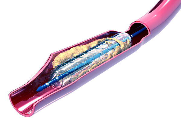 Воздушные шары расширяемый стент. Анатомическое понятие