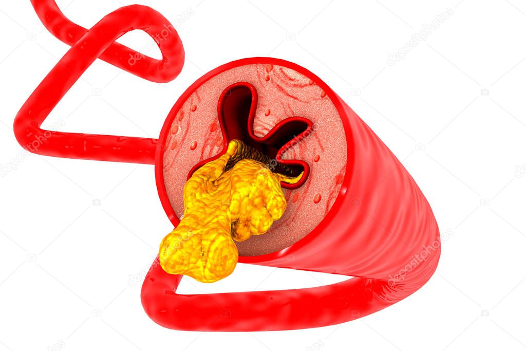 Artery blocked with cholesterol on white background.3d illustration