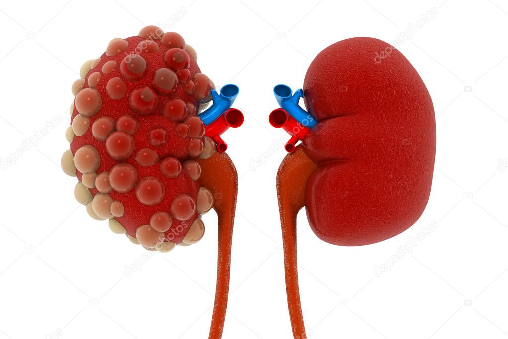 kidney disease on white background.3d illustration 