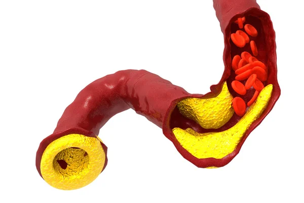 Tablica Cholesterolu Tętnicy Renderowania — Zdjęcie stockowe