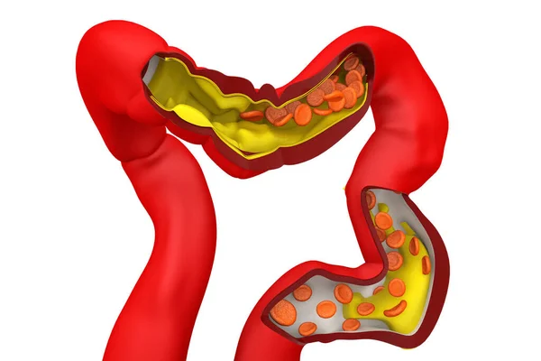 Cholesterol Plaque Artery Render — Stock Photo, Image