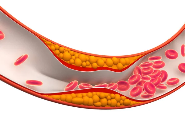 动脉内的胆固醇斑块 3D渲染 — 图库照片