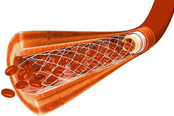 Angioplastia Stent Renderização — Fotografia de Stock