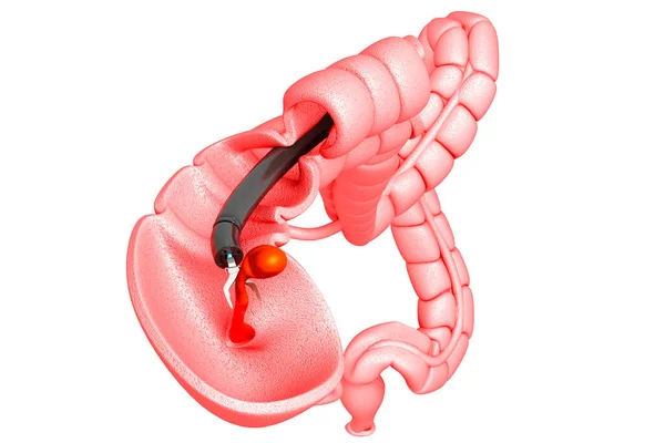 Cancro Colon Colonscopio Nel Colon Polipi Removal Rendering — Foto Stock