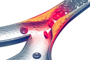 Kolesterol plaketi artery3d render
