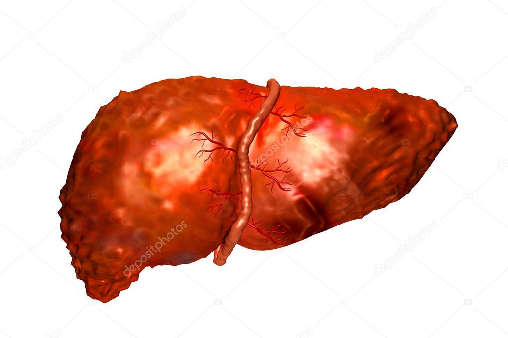 Liver disease on white background