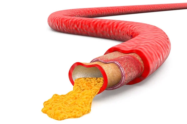 Arteria Bloqueada Con Colesterol — Foto de Stock