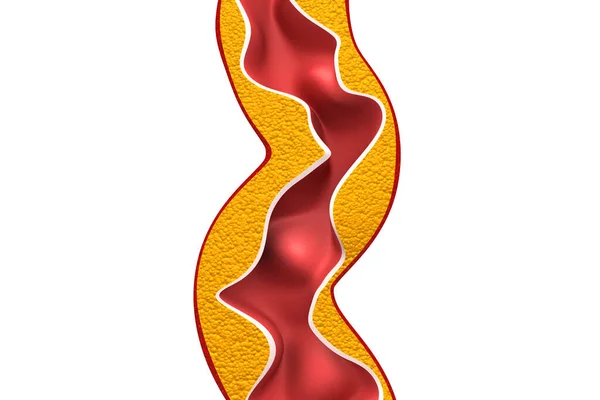 孤立背景下动脉内的胆固醇斑块 3D说明 — 图库照片