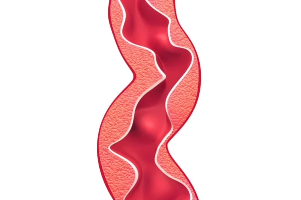 孤立背景下动脉内的胆固醇斑块 3D说明 — 图库照片