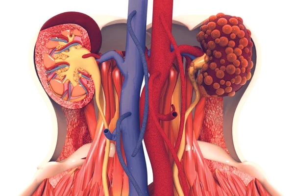 Enfermedad Renal Ilustración — Foto de Stock