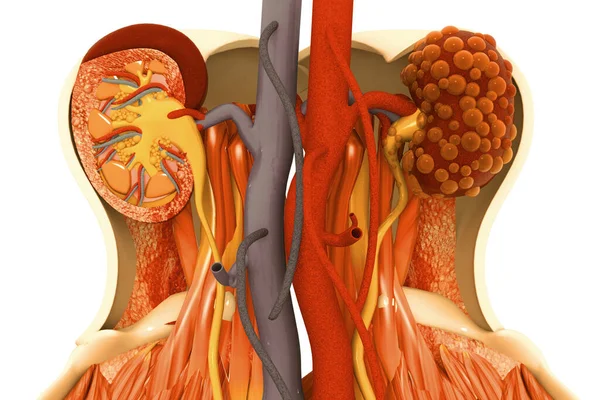 Doença Renal Ilustração — Fotografia de Stock