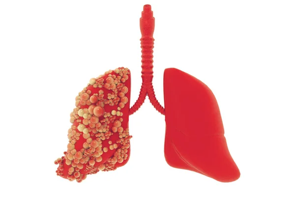 Akciğer Hastalığı Illüstrasyon — Stok fotoğraf
