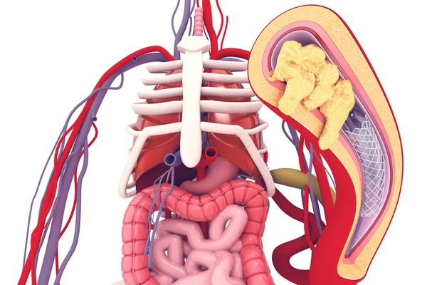 Stent Angioplastik Illustratio — Stockfoto