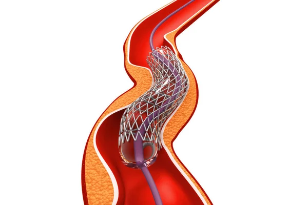 Angioplastica Stent Rendering — Foto Stock