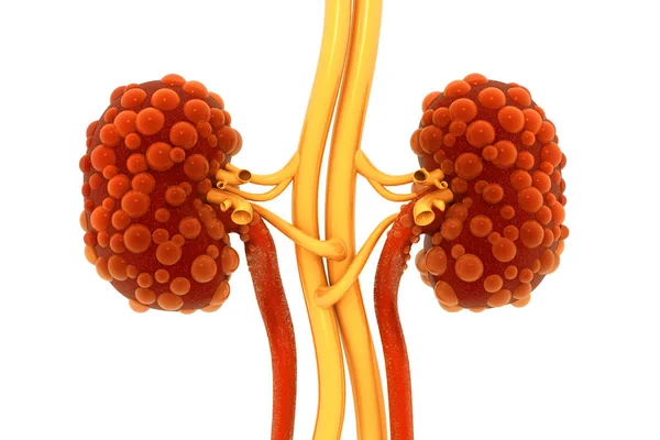 Kidney Disease Render — Stock Photo, Image