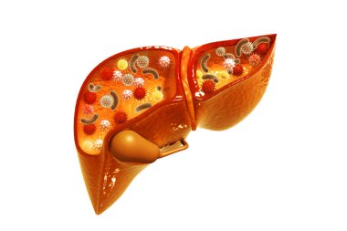 Karaciğer kanseri. 3d hazırlayıcı