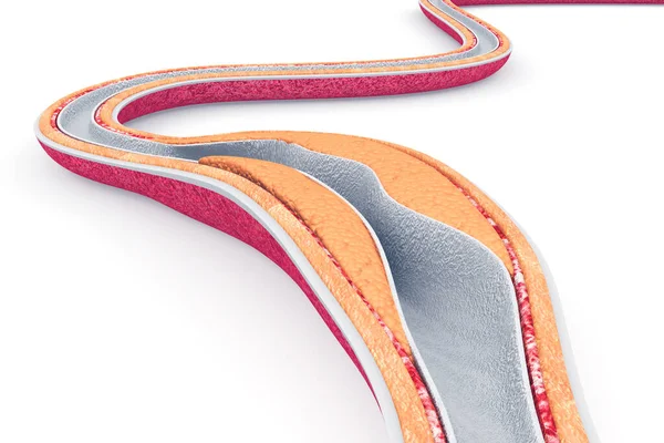 动脉内的胆固醇斑块 3D渲染 — 图库照片