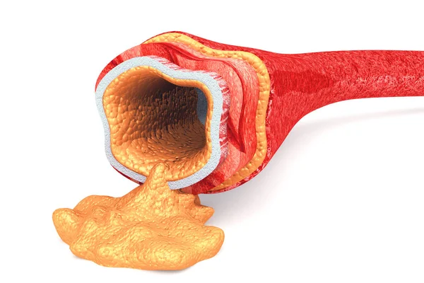 動脈のコレステロールプラーク 3Dレンダリング — ストック写真