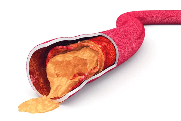 Cholesterol Deska Tepně Vykreslení — Stock fotografie