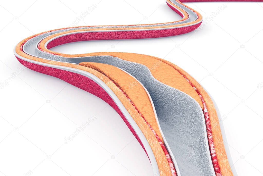Cholesterol plaque in artery.3d render