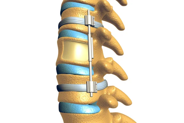 Sistema Fijación Espinal Sobre Fondo Blanco — Foto de Stock