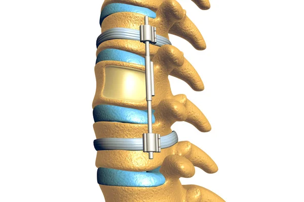 Spinal Fixation System White Background — Stock Photo, Image