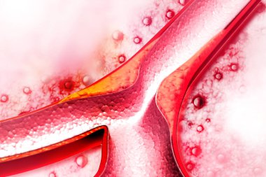 Kolesterol plaketi artery3d render