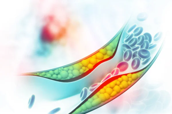 科学背景下动脉内的胆固醇斑块 3D说明 — 图库照片